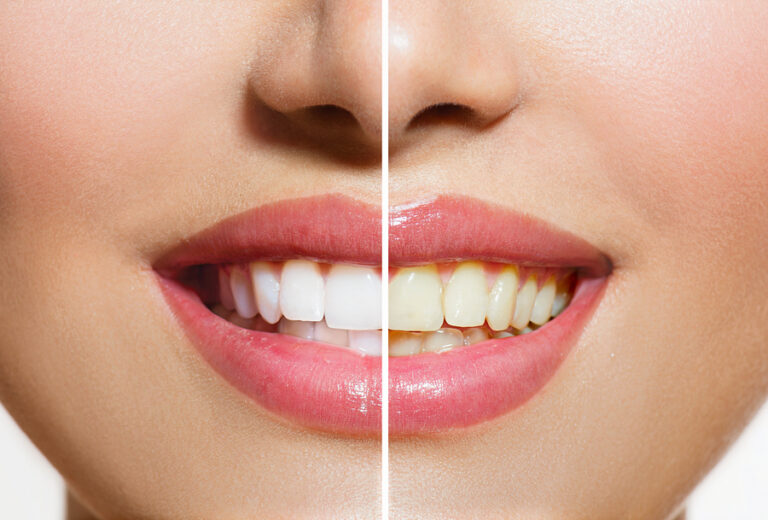 Teeth Whitening - ABS Boston